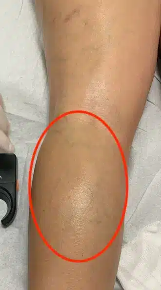 Imagen de antes de un tratamiento