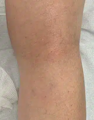 Imagen de después de un tratamiento