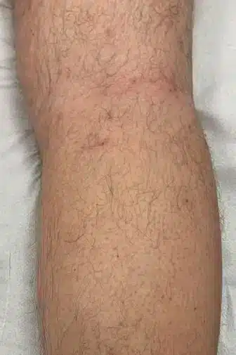 Imagen de después de un tratamiento