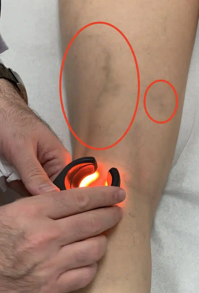 Imagen de pigmentación post-escleroterapia