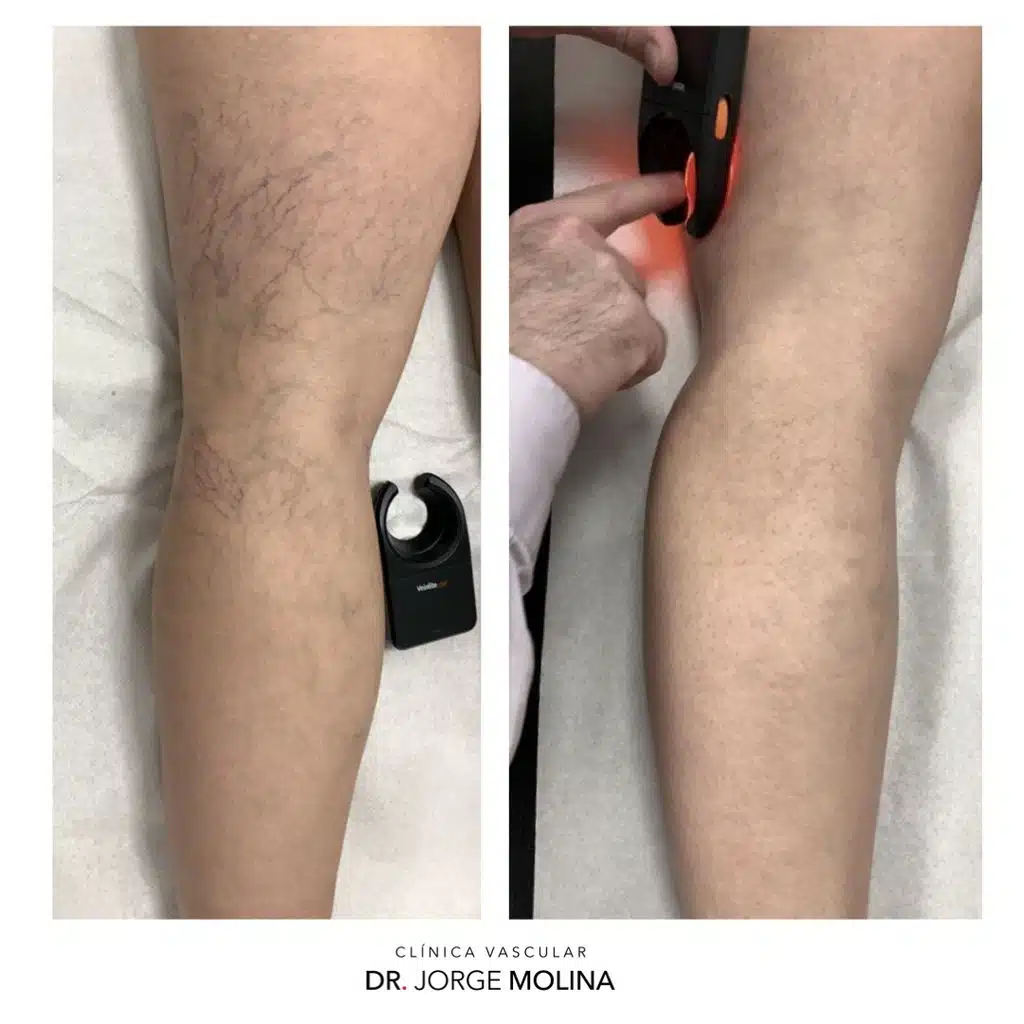 Imagen de antes y después de escleroterapia