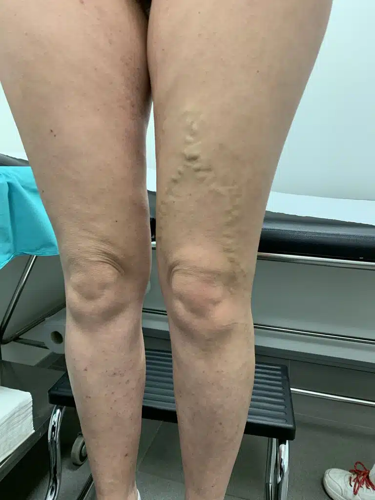 Varices