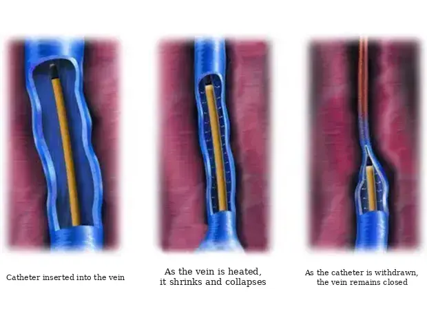 Diagram of the intravenous radiofrequency procedure