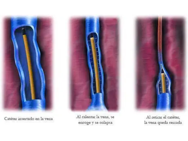 Esquema del procedimiento de radiofrecuencia endovenosa