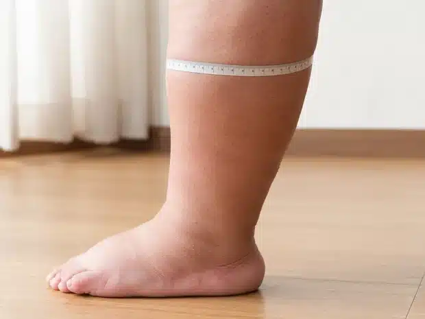 Measuring calf circumference in a person with obesity