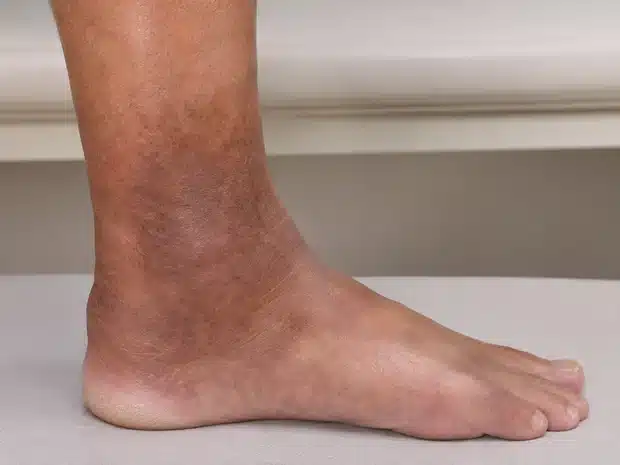 Ochre dermatitis around the ankle due to chronic venous insufficiency