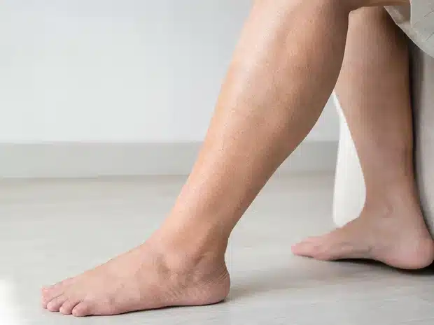 Ankle and calf during assessment of chronic venous symptoms