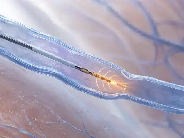 Illustration of a radiofrequency catheter working inside an insufficient vein