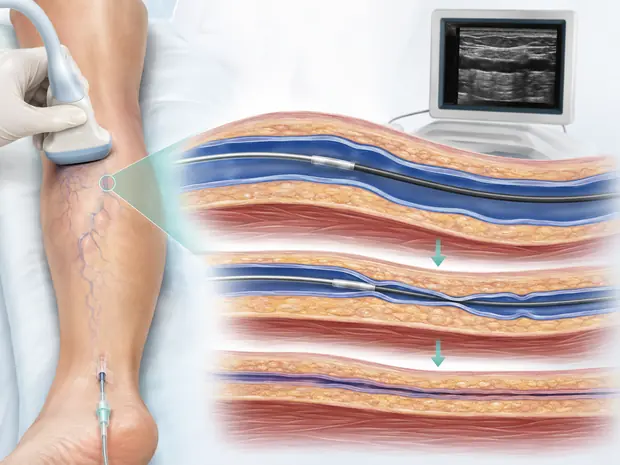 Representación de un tratamiento endovenoso de varices guiado por ecografía