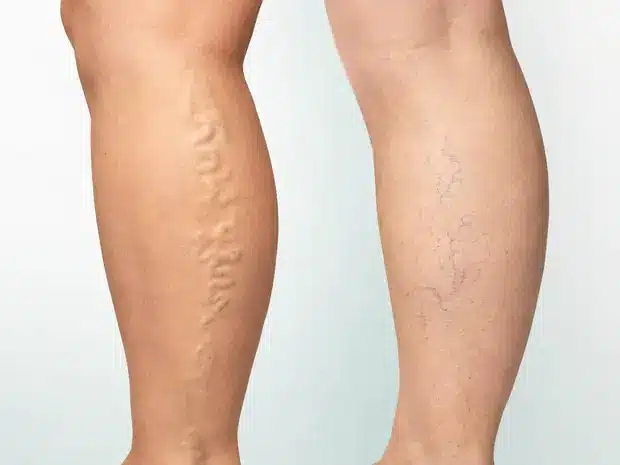 Comparación entre varices de mayor calibre y arañas vasculares en las piernas